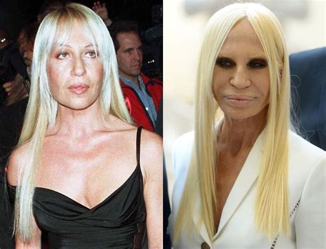 Here’s How Donatella Versace’s Plastic Surgery Transformed 